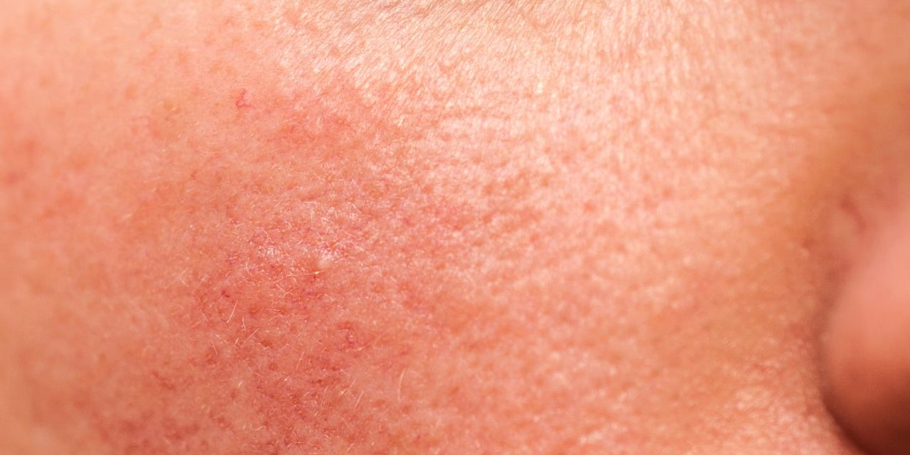 Rougeurs, imperfections et pores dilatés Azul Cosmétique