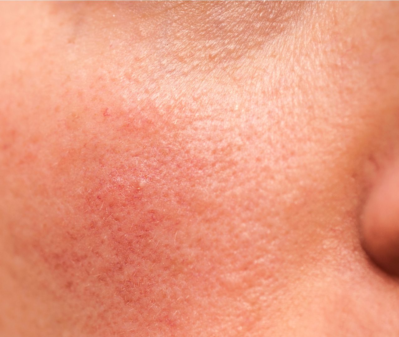 Rougeurs, imperfections et pores dilatés Azul Cosmétique